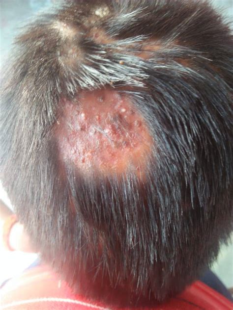 Folliculitis Of Scalp In Child Cured With Homeopathy Case Study