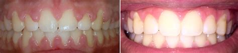 Gum Laser Recontouring Johnson Orthodontics