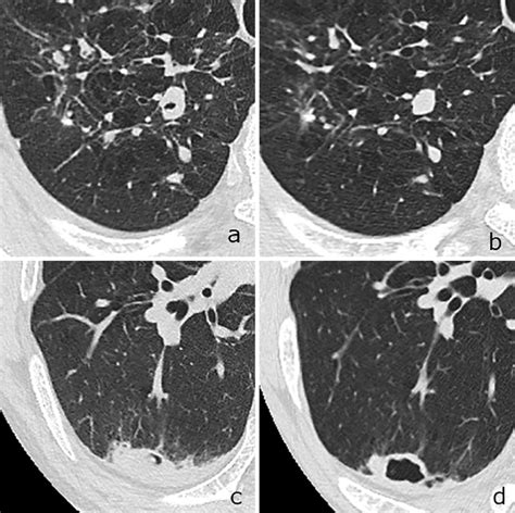 Figure The Computed Tomography Findings At The Patient S First Visit