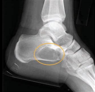 Unicameral Bone Cyst Of The Calcaneus Journal Of Orthopaedic Sports Physical Therapy