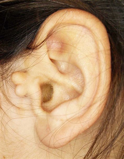 Ear Skin Tags In Babies And Their Removal Fauquier Ent Blog