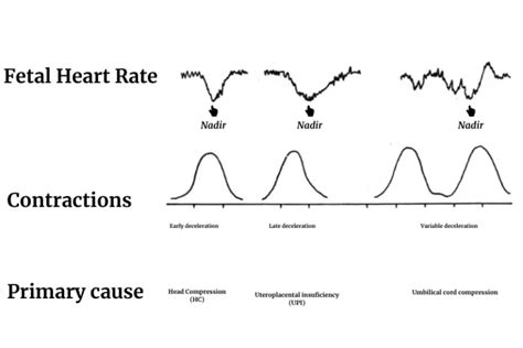 Fetal Heart Rate Monitoring And Veal Chop Mine In Nursing