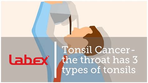 Tonsil Cancer — The Throat Has 3 Types Of Tonsils By Laryngectomy