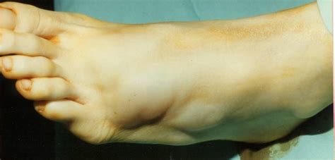 Ganglion Cyst The Foot And Ankle Online Journal