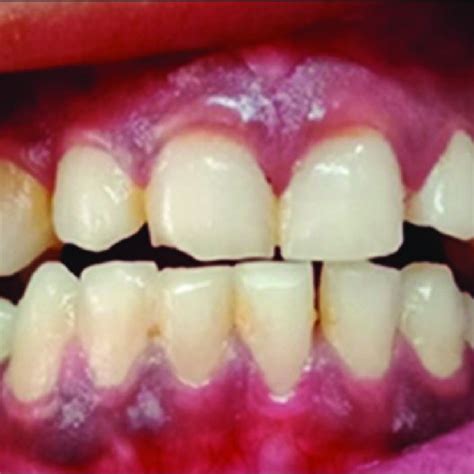 Mild Erythema And Ulceration Of Gingiva Associated With Pemphigus