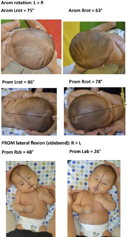 Bathing your baby too much can dry out his or her skin. Measurements of a 4-month-old infant with bilat ...