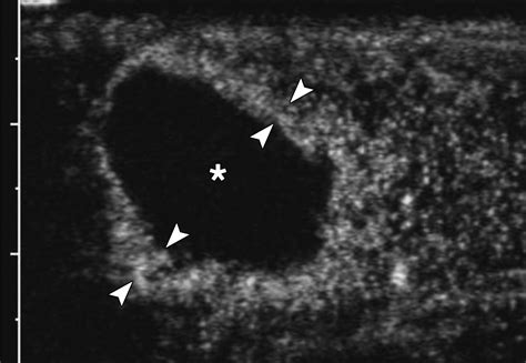 Acute Segmental Testicular Infarction At Contrast Enhanced Ultrasound