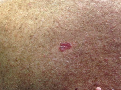 Common Skin Lesions