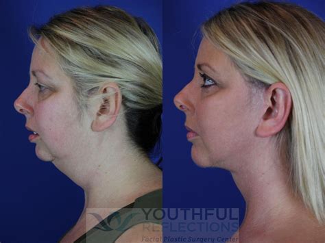 Chin Implant Before After Photos Patient Nashville Tn Youthful Reflections