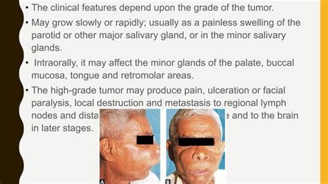 Parotid Gland Swelling Ppt