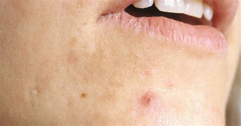 Everything You Ever Wanted To Know About Cystic Acne Huffpost Uk