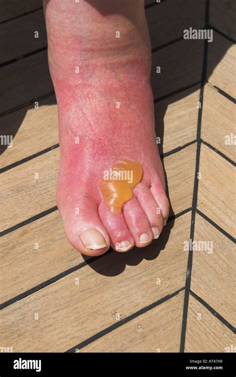 A Badly Sun Burnt Foot Stock Photo Alamy