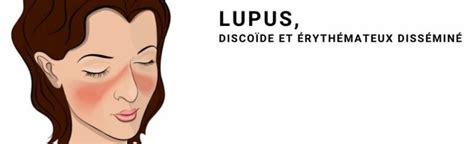 Lupus Définition Symptômes Diagnostic Traitement
