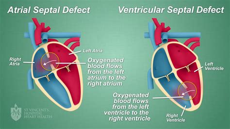 Septal Defect Hole In The Heart Closures St Vincents