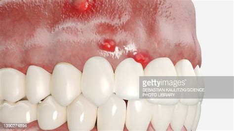 Tooth Abscess Photos And Premium High Res Pictures Getty Images