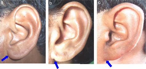 Ear Lobe Attachment A Free B Partially Attached C Attached