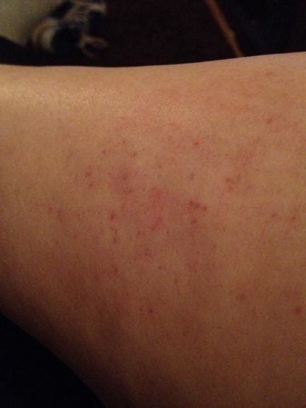 Red Dots On Legs Netmums Chat