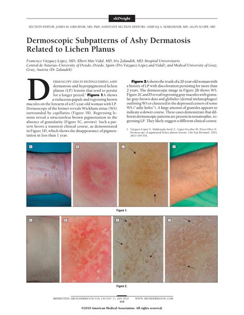 Dermoscopic Subpatterns Of Ashy Dermatosis Related To Lichen Planus