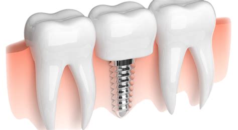 What Is Dental Implant Dr Buğra Yılmaz