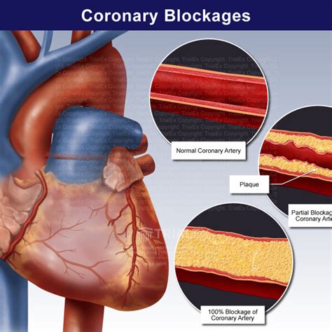 Coronary Blockages Trialexhibits Inc
