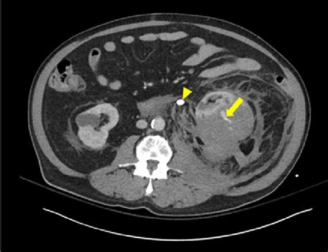 Axial Ct Scan Of The Chest Abdomen And Pelvis With Iv And Oral Fd0