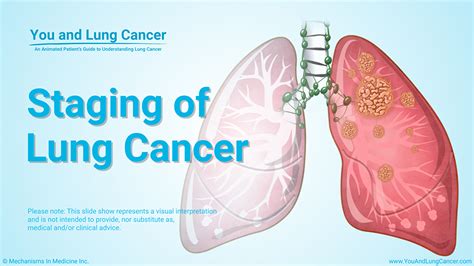 Slide Show Diagnosis And Screening Of Lung Cancer