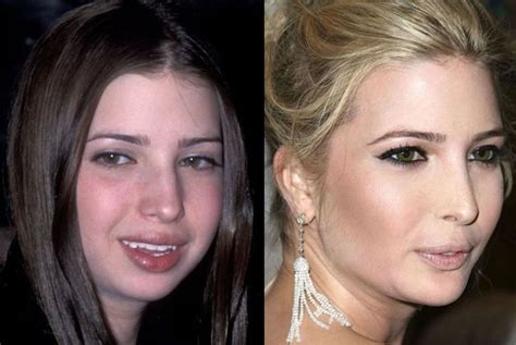 Plastic Surgery Disasters Before And After Page 11