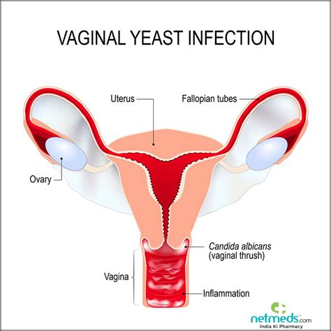 Vaginal Yeast Infection Candidiasis Ginecological Medical Desease Infographic Vector