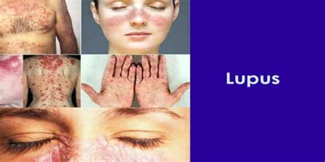 Lupus Assignment Point