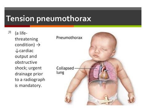 Neonatal Respiratory Distress