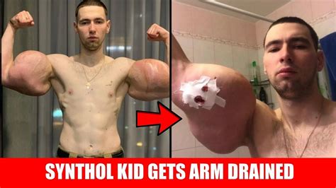 Synthol Before After