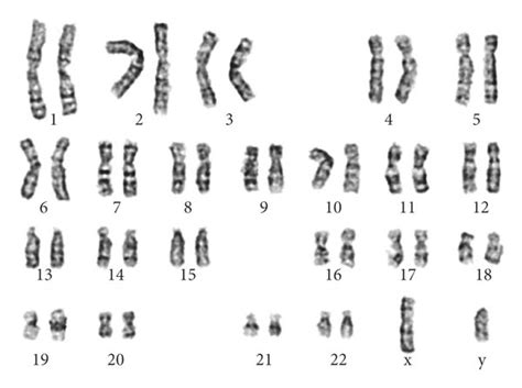 The Mosaic Karyotype Of The Patient Identified By Gtg Banding Technique Download Scientific