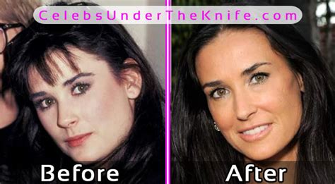 Demi Moore Best Plastic Surgery Pics Celebs Under The Knife
