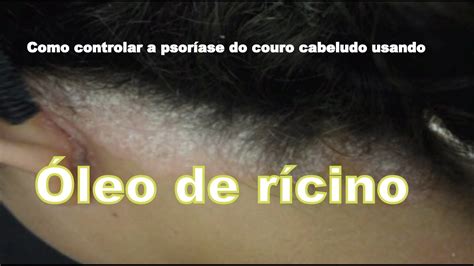 Como Controlar A Psoríase Do Couro Cabeludo Usando óleo De Rícino Youtube