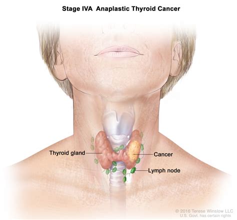 Figure Stage Iva Anaplastic Thyroid Cancer Pdq Cancer