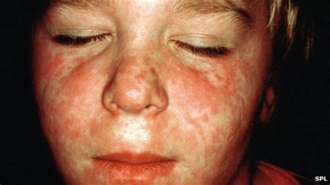 A Million Children At Risk Of Measles Doctors Warn Bbc News