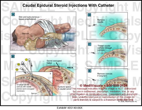 Comparison of caudal epidural injections of bupivacaine and methylprednisolone with bupivacaine followed by saline. Caudal Epidural Steroid Injections With Catheter Medical ...