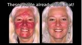 Photos of Levulan Blue Light Treatment For Skin Cancer