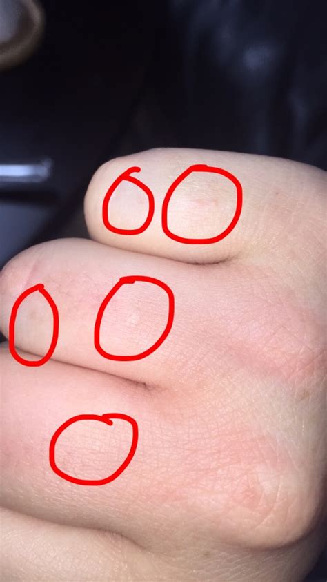 Small Itchy Bumps On Hands And Feet Causes Treatments Vrogue Co