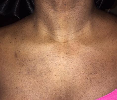 Why Do I Have Little Bumps On My Chest Design Talk