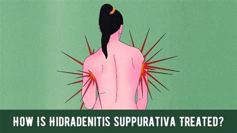 How Is Hidradenitis Suppurativa Treated