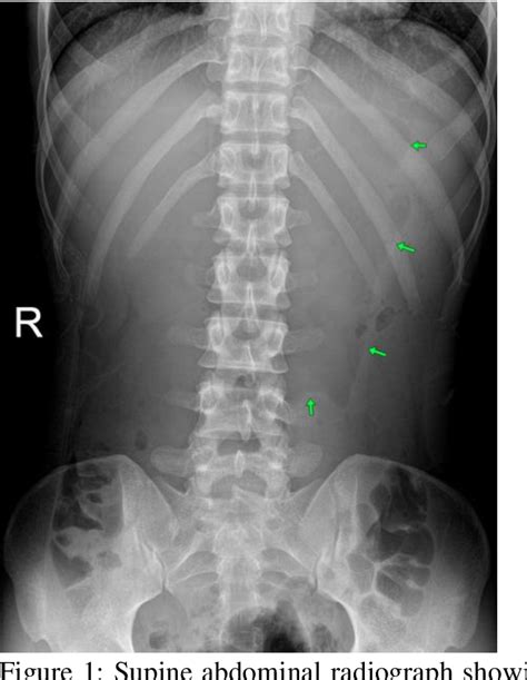 Figure 1 From Superior Mesenteric Artery Syndrome As An Atypical