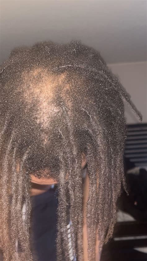 Any Recommendations To Get This Bald Spot To Grow Back Rdreadlocks