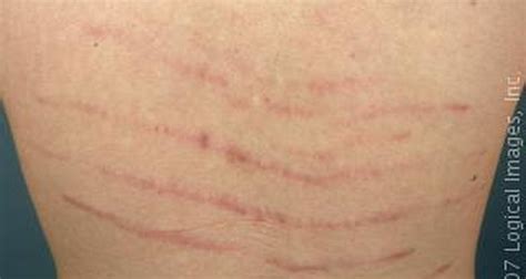 What Causes Stretch Marks On The Lower Back