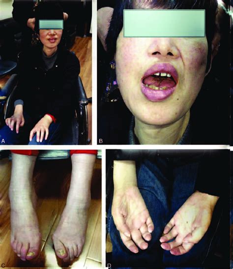 A Case Of Amyotrophic Lateral Sclerosis Patient Was Treated By Using A