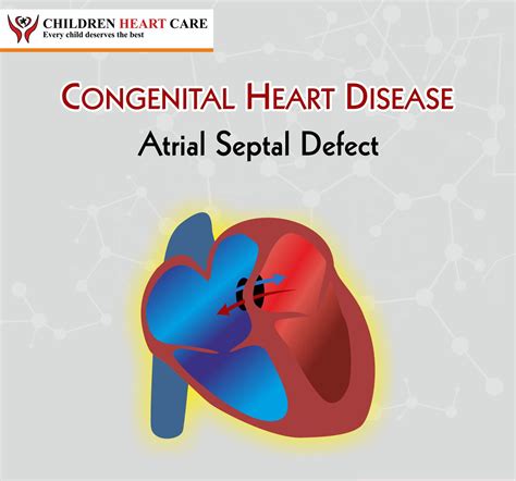 Atrial Septal Defect Asd Blog Dr Gaurav Agrawal