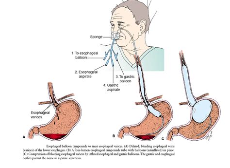 Surgical Procedures For Oesophageal Varices