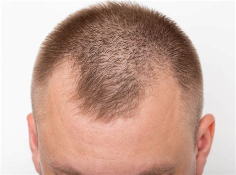 A Quick Guide To Fighting And Preventing Hair Loss On Temples Pinkvilla