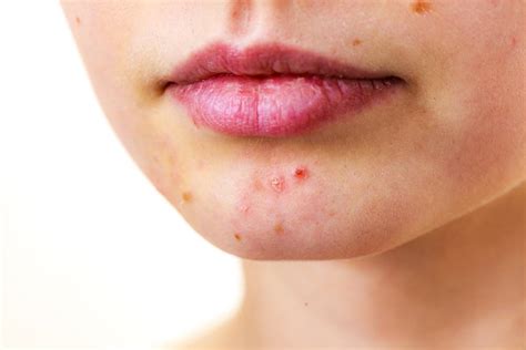 Surprising Causes Of Adult Acne And What You Can Do About It Orange Coast Dermatology