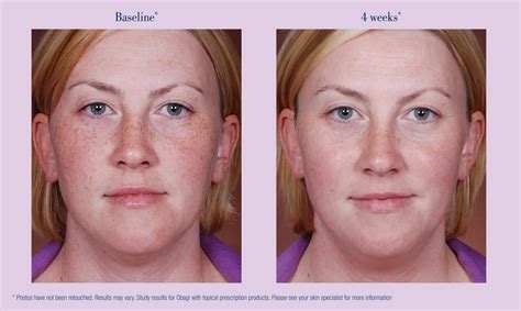 Obagi C Rx Correct Early Signs Of Ageing Sydney Skin Clinic